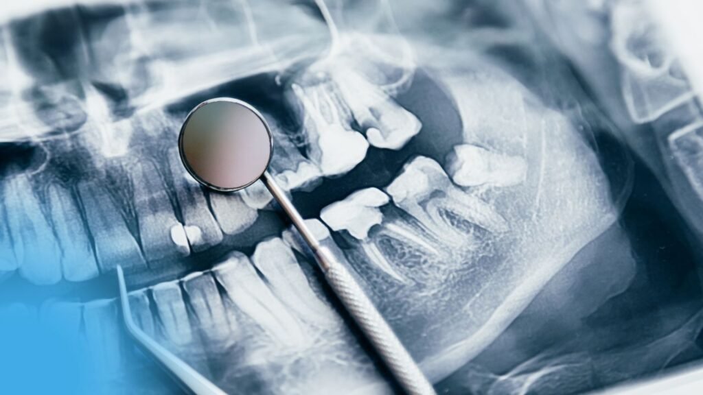 Traumi ai denti temporanei e ai denti permanenti immaturi e loro gestione